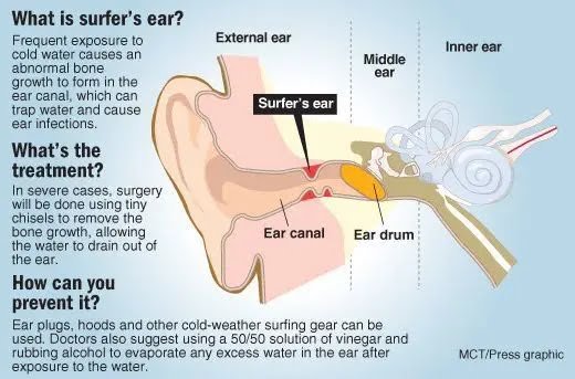 The surfer's ear 