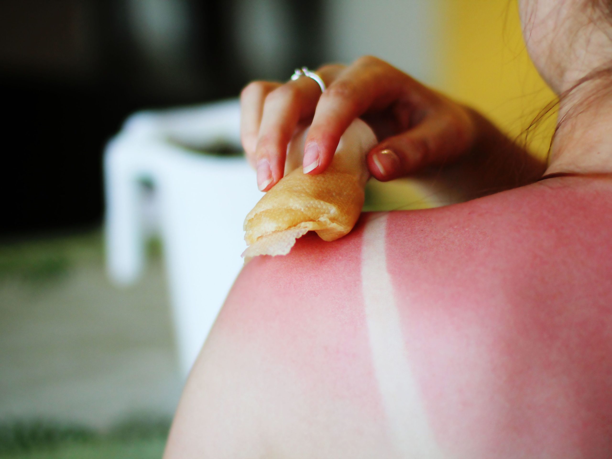 Quemaduras de sol y surf: 5 remedios caseros para tratarlas.